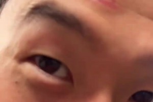 孙兴慜的脑门肿了一块，但拿了奖牌的孙哥高兴得合不拢嘴！🫠