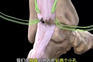 看着都疼啊😭😭科普帖：球员脚跟腱断裂是如何进行修复的？